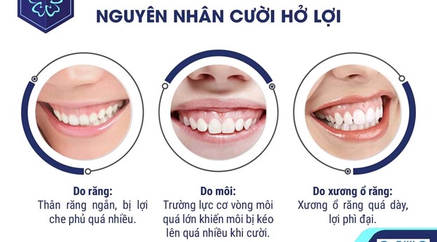Một vài nguyên nhân gây hở lợi khi cười