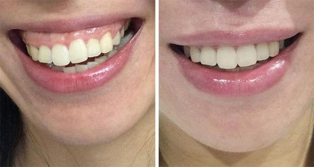 Điều trị cười hở nướu bằng cách tiêm Botox
