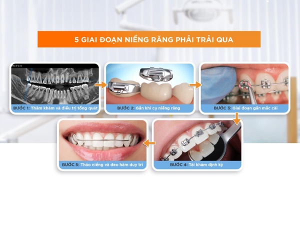 Niềng răng có bao nhiêu giai đoạn?