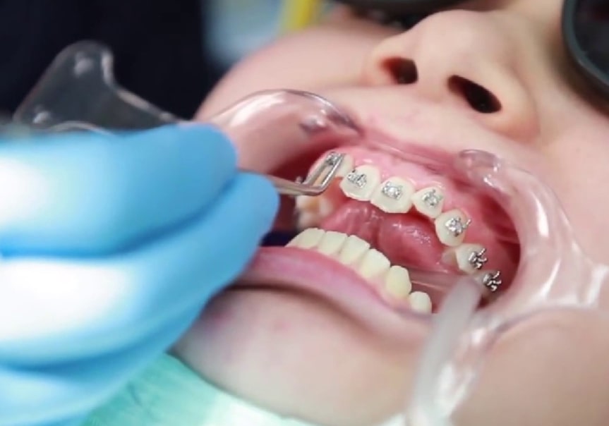 Kỹ thuật niềng răng rất quan trọng Nguyên nhân gây ra tình trạng hóp thái dương khi niềng răng