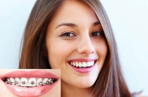 Giữ vững tinh thần thoải mái khi niềng răng Giữ vững tinh thần thoải mái khi niềng răng