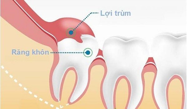 Lợi trùm răng khôn gây đau đớn