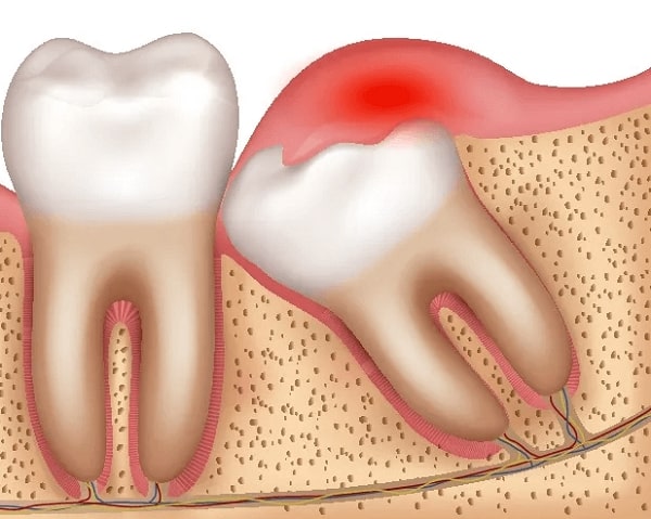 Lợi trùm răng khôn tùy trường hợp để áp dụng cách điều trị khác nhau