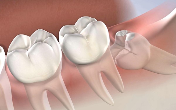 Biểu hiện của việc mọc răng khôn nổi hạch cổ?