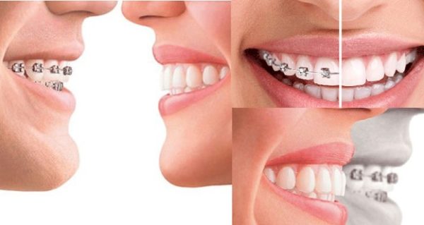 Niềng răng và bọc răng sứ