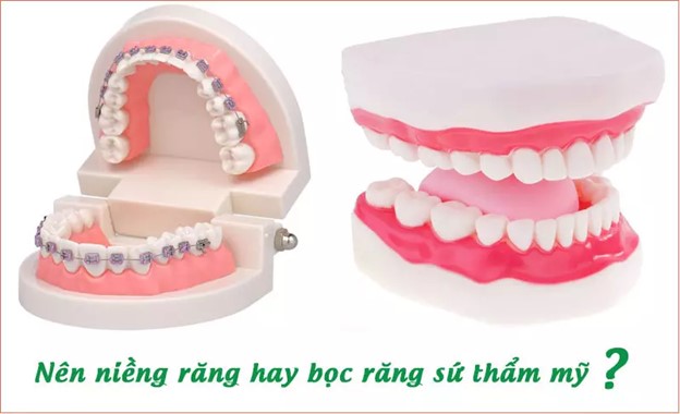 Nên niềng răng hay bọc răng sứ