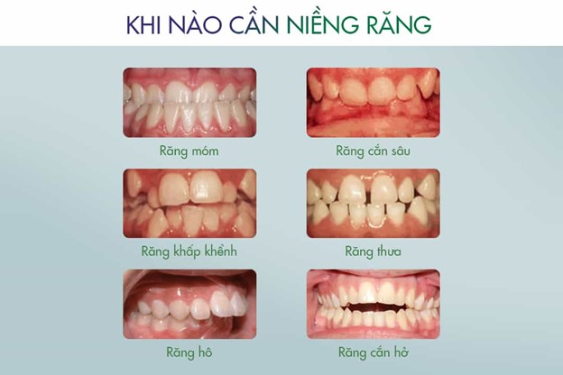 Các trường hợp nên niềng răng