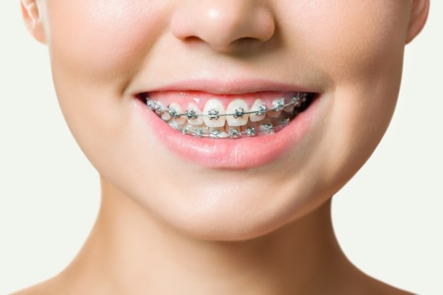 Minh họa ưu nhược điểm của niềng răng