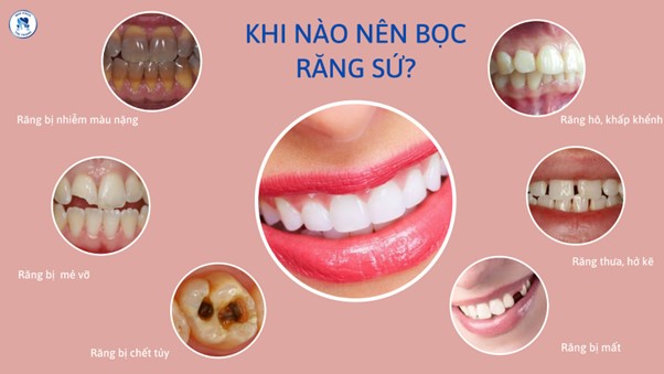 Khi nào cần bọc răng sứ