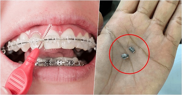 Tại sao có tình trạng nuốt niềng răng vào bụng?