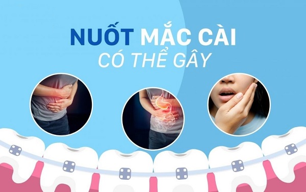 Nuốt niềng răng, mắc cài có gây nguy hiểm?