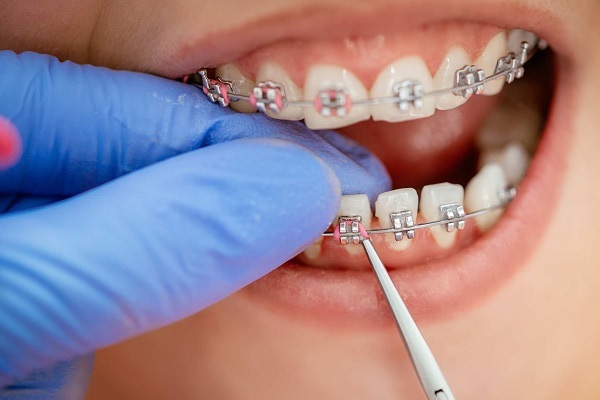 Cách hạn chế việc bung sút mắc cài khi đang niềng răng