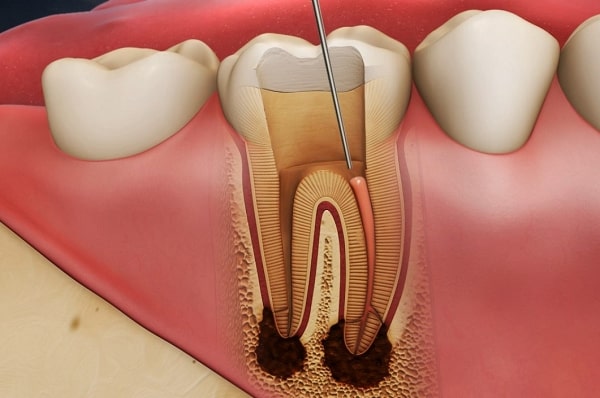 Răng chết tủy cần được điều trị kịp thời Cách điều trị cho răng bị chết tủy
