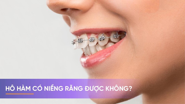 Hô hàm có niềng răng được không là thắc mắc của rất nhiều người