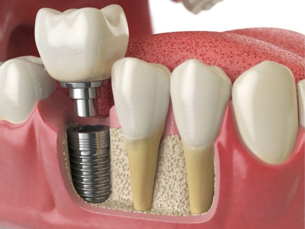 Trồng răng Implant là giải pháp cải thiện mất răng số 7 tốt nhất