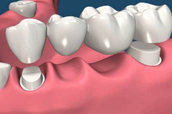 Trồng cầu răng sứ có nhiều hạn chế, cần theo chỉ dẫn bác sĩ