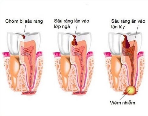 Răng hàm sâu có nên nhổ không là vấn đề được nhiều người quan tâm