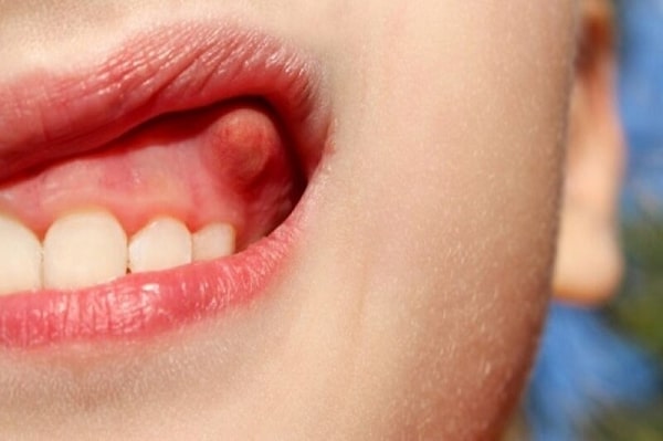 Nổi áp xe, gây đau răng chướm nóng hay lạnh?