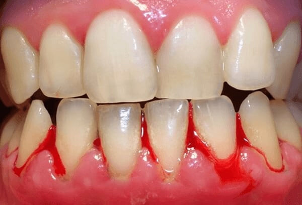 Chấn thương gây đau răng nên uống thuốc gì?