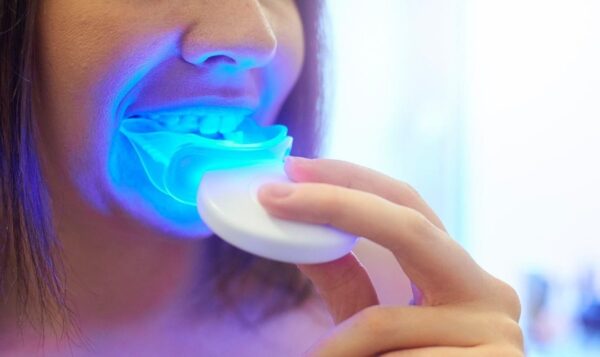 Có nên sử dụng máy tẩy trắng răng hay không? Những ai nên sử dụng và những ai chưa nên sử dụng?