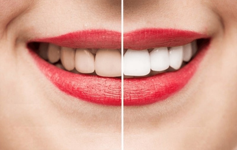 Cách khắc phục triệu chứng đau khi tẩy trắng răng