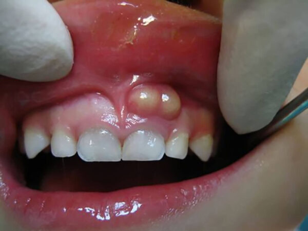 Tủy bên trong bị lộ rõ do gặp chấn thương cũng sẽ gây nên áp xe răng