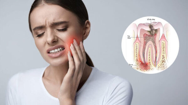 Áp xe răng không điều trị kịp thời sẽ ngăn chặn biến chứng và nhiễm trùng
