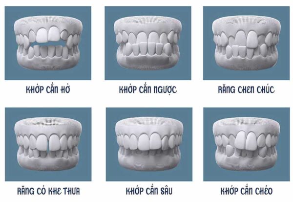 Tìm hiểu nguyên nhân và cách khắc phục đeo hàm duy trì vẫn bị chạy răng