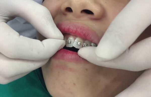 Thực hiện niềng răng lại