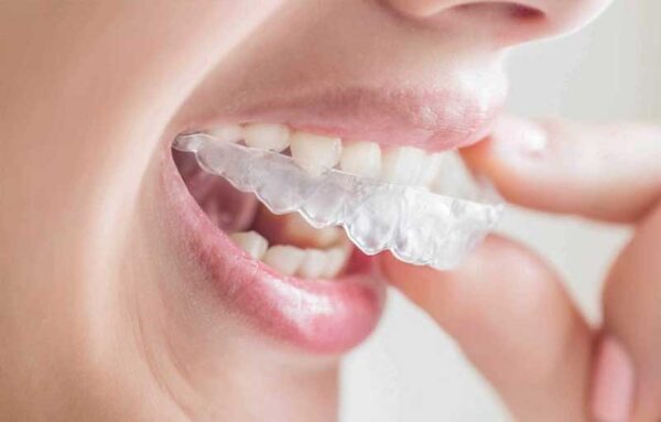 Thiết kế lại kích cỡ của hàm duy trì