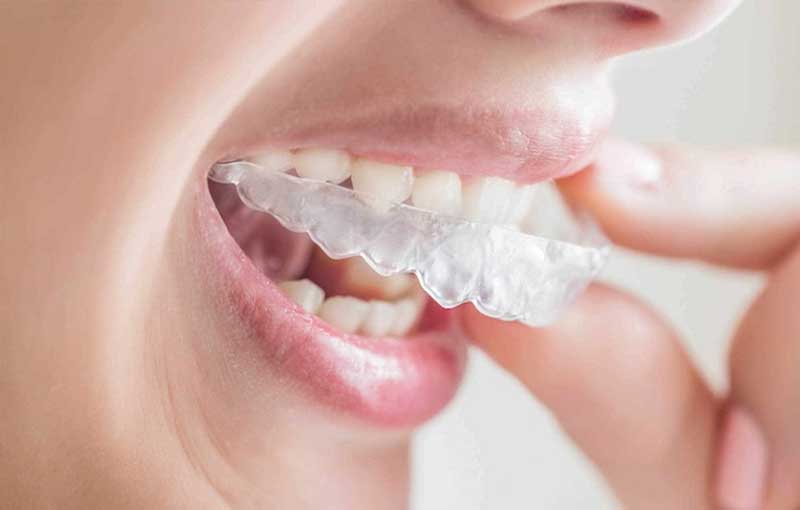 Thiết kế lại kích cỡ của hàm duy trì