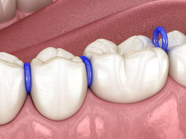 Thun tách kẽ là gì, vì sao phải đeo vào răng trước khi niềng?