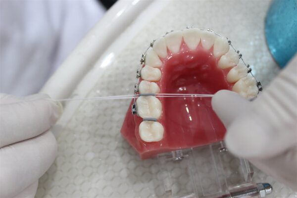 Quy trình đặt thun chỉ diễn ra trong khoảng 5 phút