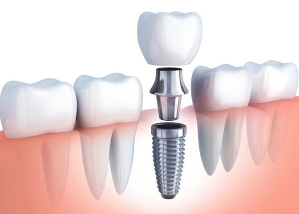 Implant răng