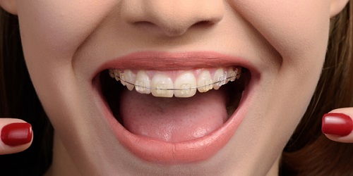 Nha khoa Platinum  - địa chỉ niềng răng chỉnh nha uy tín và chất lượng