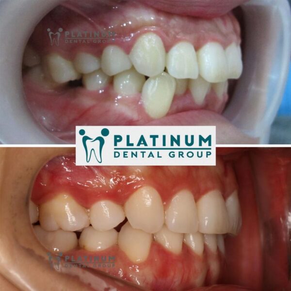 Nguyên nhân dẫn đến niềng răng bị hô trở lại