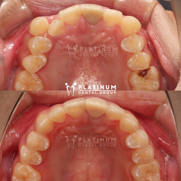 Răng sâu có niềng được không