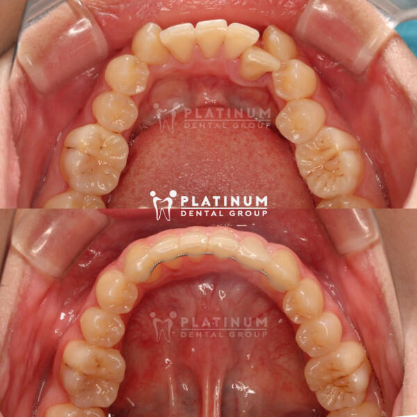 Răng sâu có niềng được không