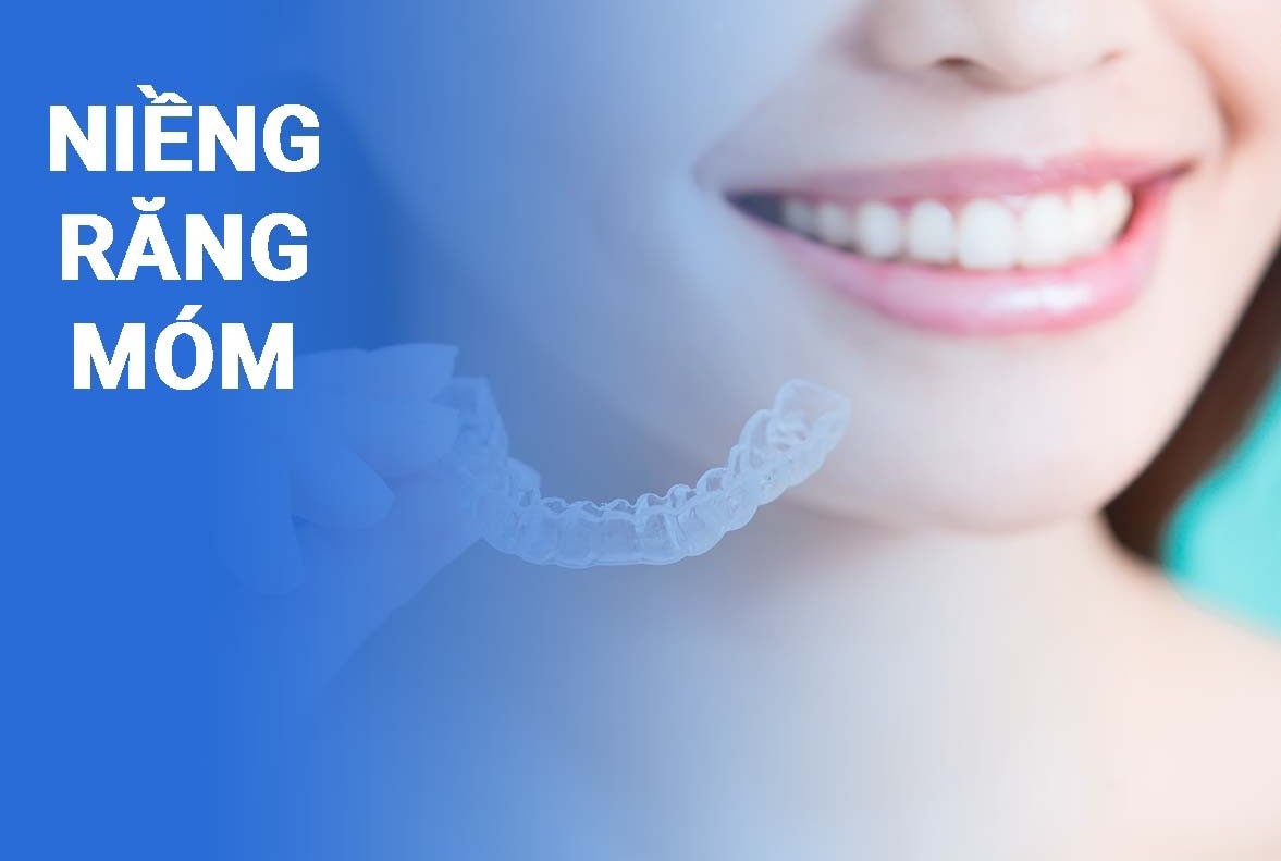 Hiện nay, niềng răng móm bao nhiêu tiền ?