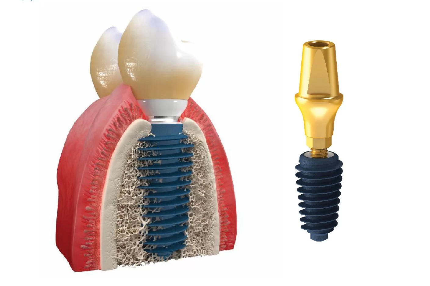 Implant Megagen
