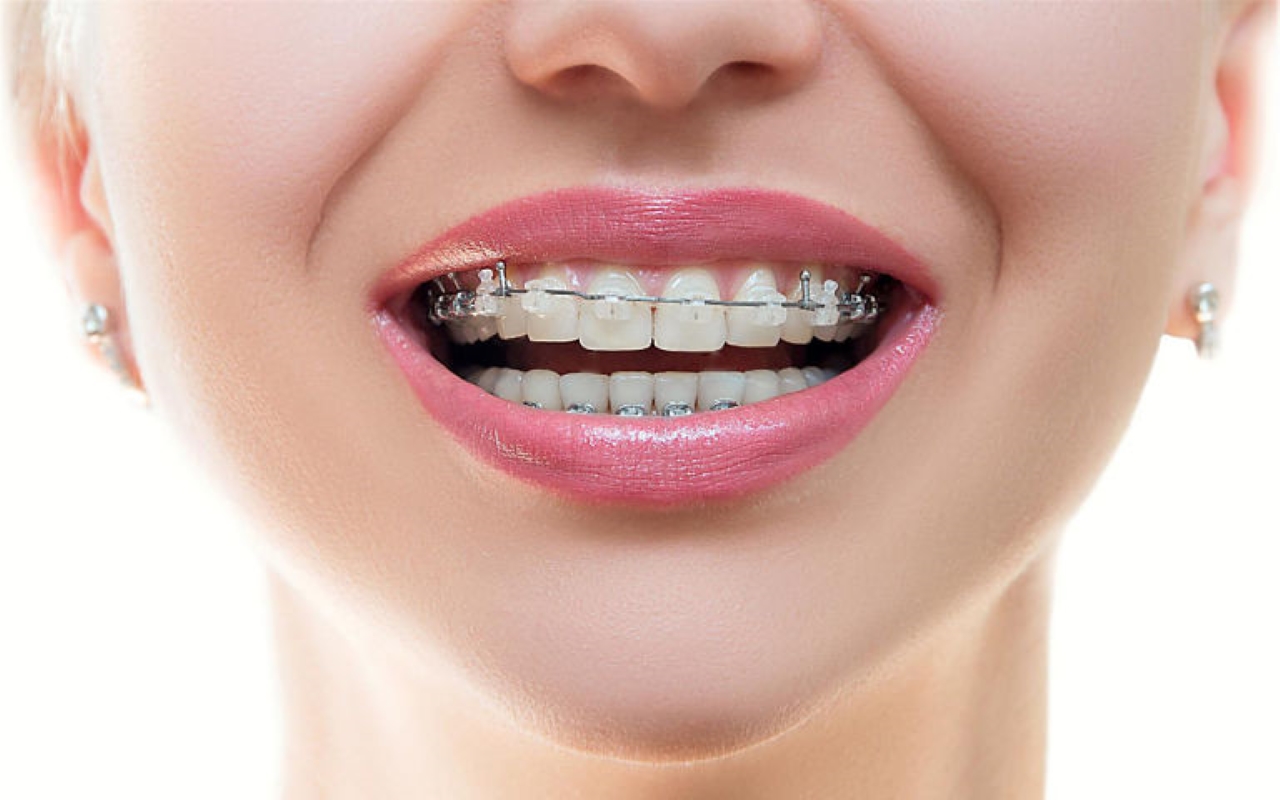 Những điều cần chú ý khi niềng răng mắc cài pha lê