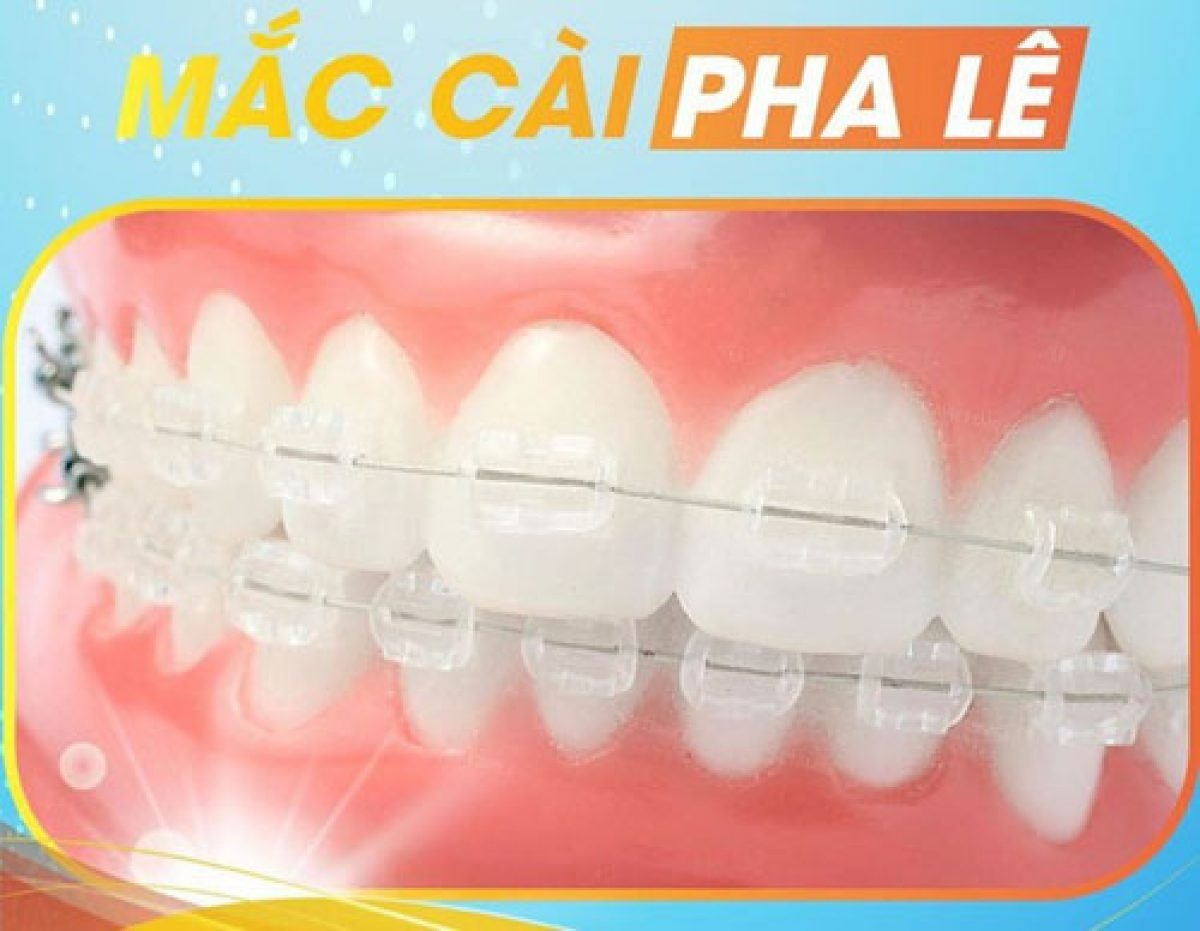 Niềng răng mắc cài pha lê có giá khoảng bao nhiêu?