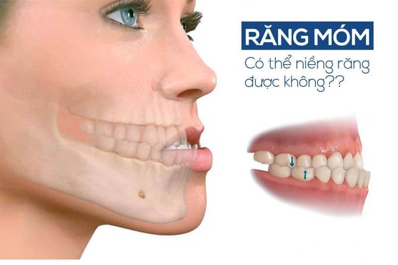 Niềng răng móm có hiệu quả ra sao?