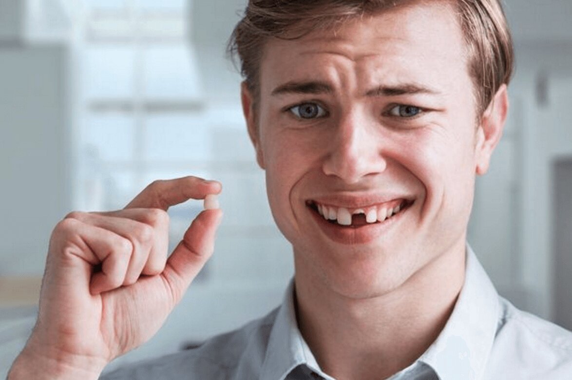 Tác hại của việc mất hoặc tổn thương răng cửa