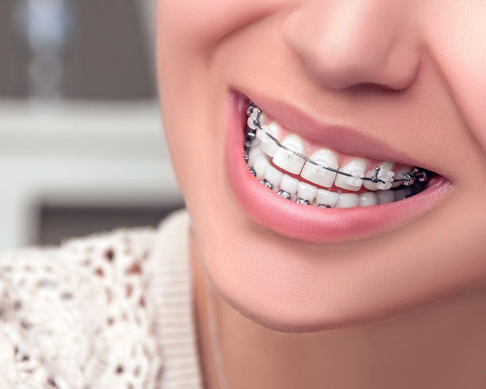 Tìm hiểu về vấn đề niềng răng có phải nhổ răng không?