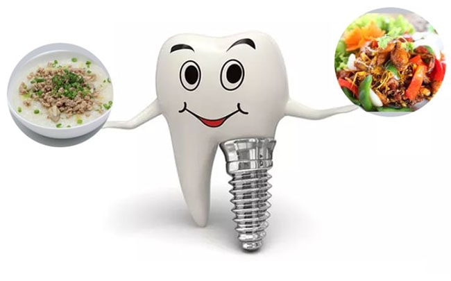 Trồng răng Implant bao lâu thì ăn được?