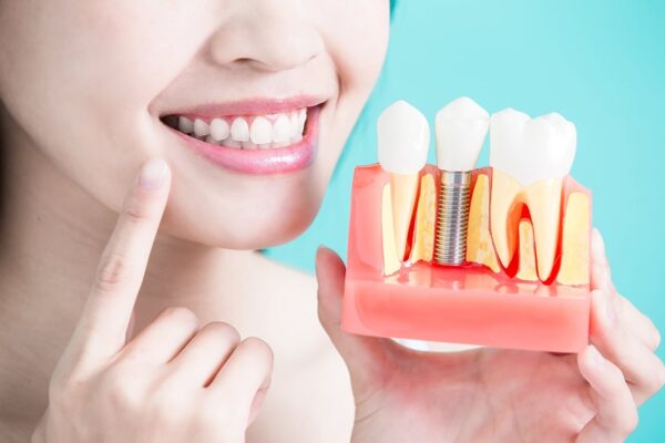 Tuổi thọ của phương pháp implant phụ thuộc vào nhiều yếu tố