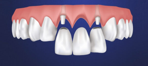 Are crown bridge front teeth well?