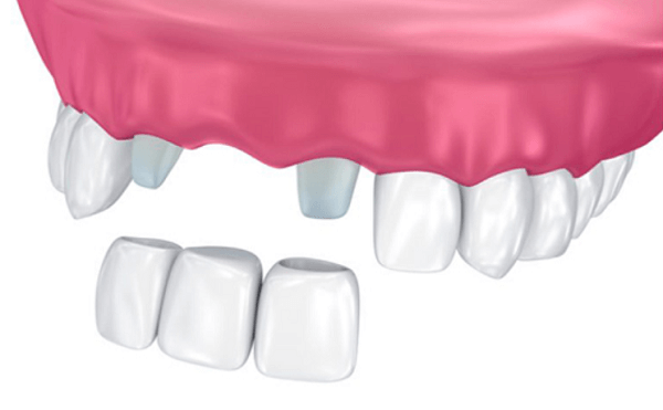 Some notes when applying crown bridge in front teeth