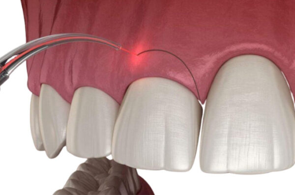Crown lengthening: A to Z information